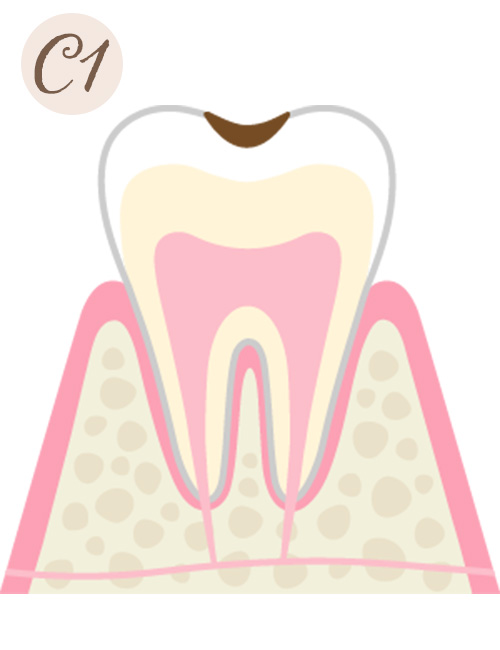 軽度の虫歯（C1）