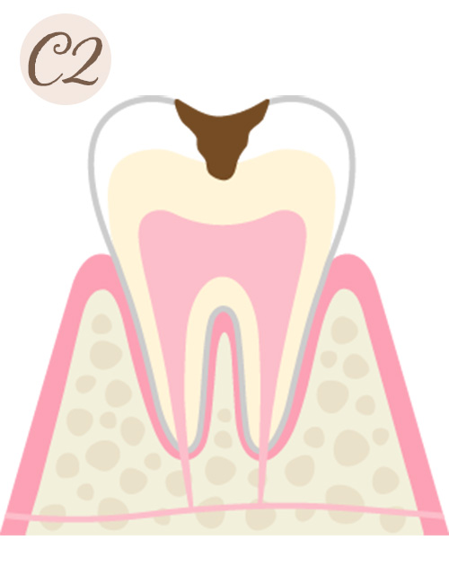 中等度の虫歯（C2）