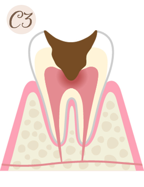 中等度の虫歯（C3）