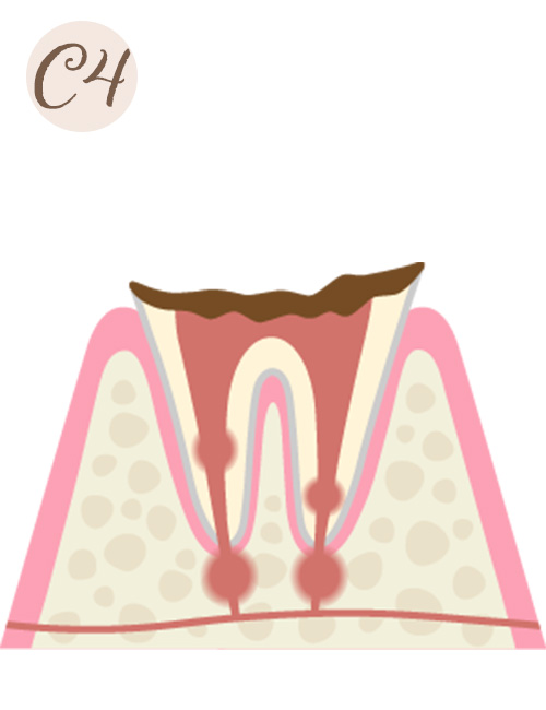 重度の虫歯（C4）